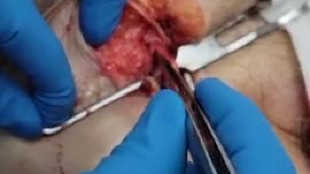 Embalmer Pulls Out Long Bloodclots From Vaxed Dead People.  Not Normal