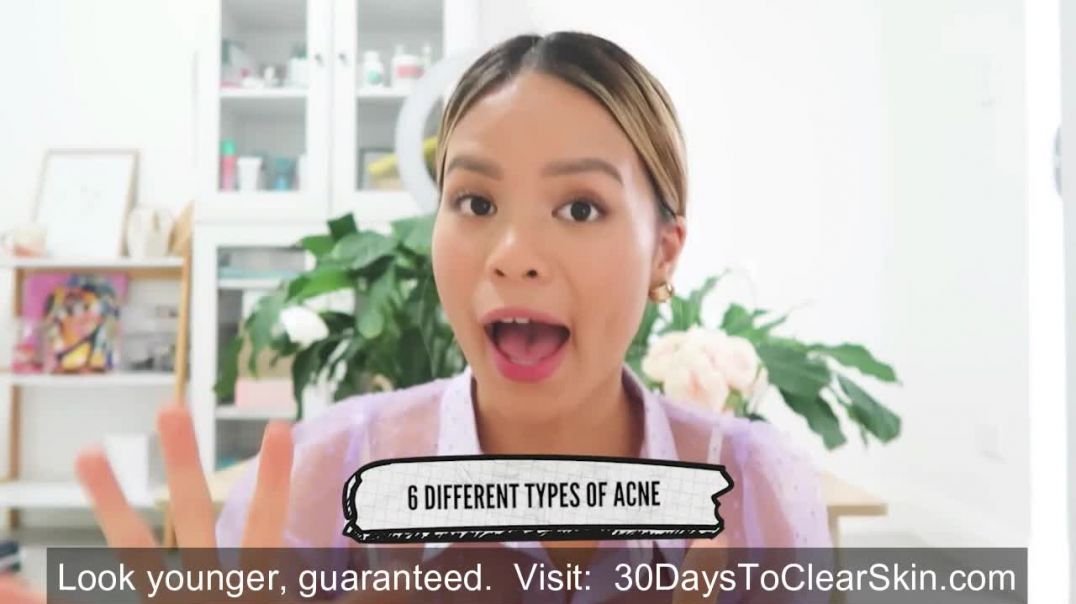 How to treat EVERY type of acne (With Pictures )
