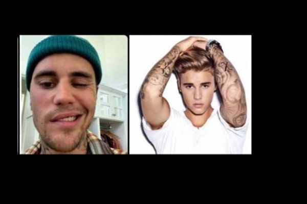 Justin Bieber cancels entire world tour for 2023 due to post-covid “vaccine” facial paralysis