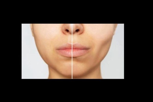 More About Ozempic Face