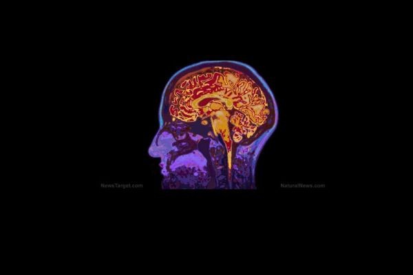 Cases of Creutzfeldt-Jakob Disease Increase After COVID-19 Vaccination